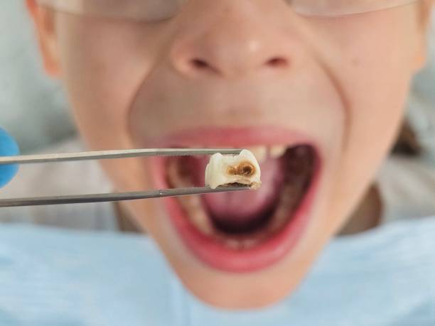 Best Emergency Treatment for Dental Infections or Abscesses in Stoughton, WI